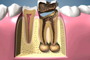 Cavity Progression